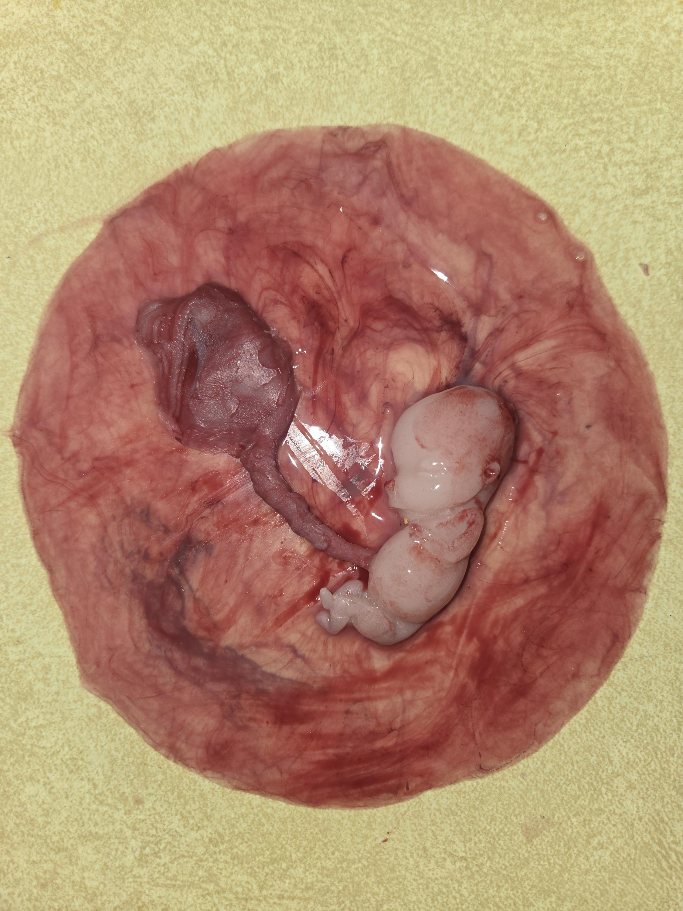 Warning graphic 12 week gestational fetus silicone memorial baby inside silicone womb with placenta attached