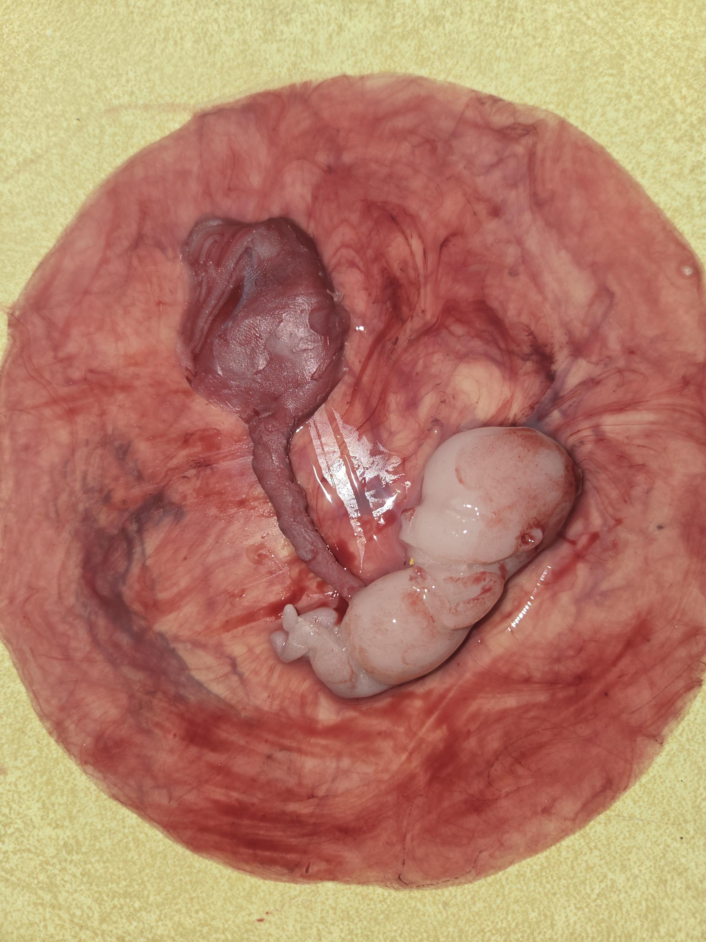 Warning graphic 12 week gestational fetus silicone memorial baby inside silicone womb with placenta attached
